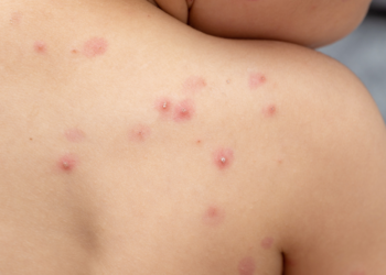 Asturias confirma sus dos primeros casos de viruela del mono