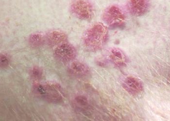 Detectados dos nuevos casos de viruela del mono en Asturias, sin relación entre sí ni con los primeros afectados