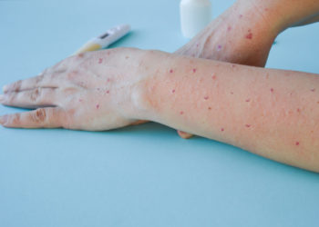 Sanidad notifica 57 casos de viruela del mono en Asturias