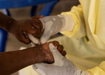 Sanidad llama a la calma: los casos de ‘viruela del mono’ detectados en España en 2024 no difieren de los que había desde 2022